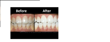 Whitening Pictures2