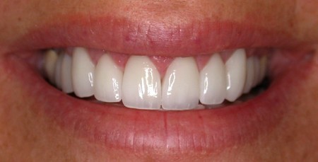 Porcelain Veneers